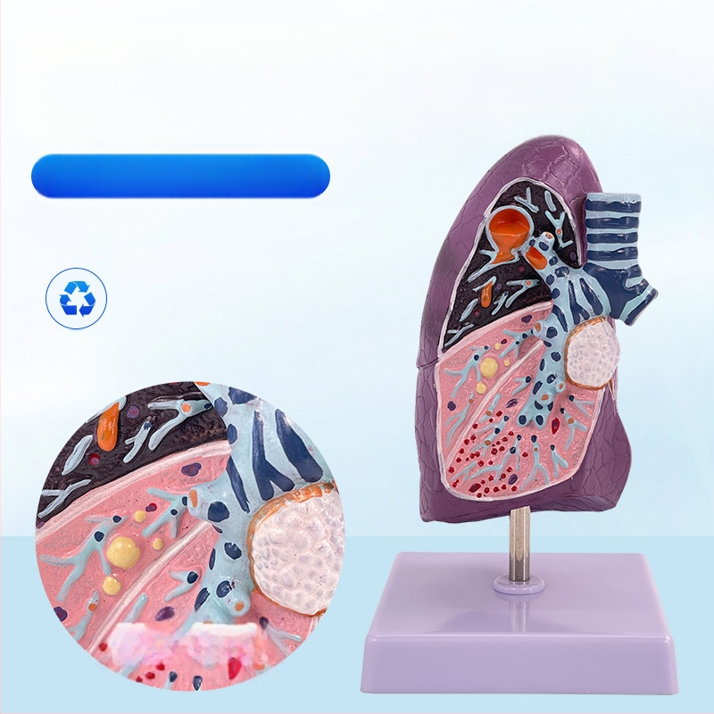 Blue Butterfly пластмасов модел на вътрешни органи: човешка трахея и белите дробове - анатомия и патология с разрез на пушач.