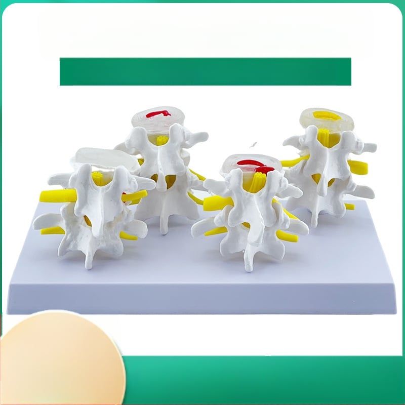 Blue Butterfly PVC четирисекционен модел на лумбалния гръбнак: нормални и патологични прешлени с дискова патология