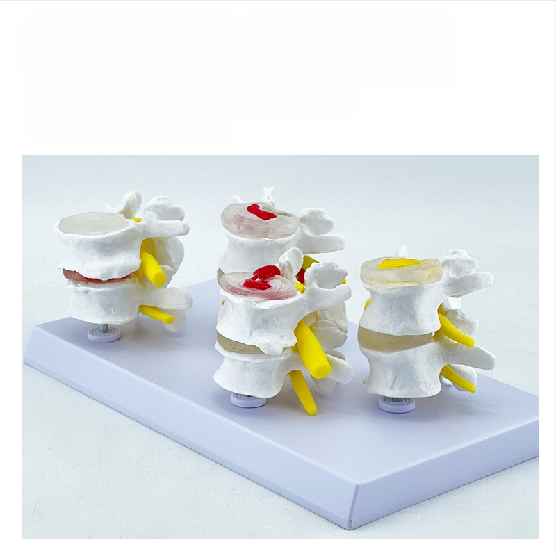 Blue Butterfly PVC четирисекционен модел на лумбалния гръбнак: нормални и патологични прешлени с дискова патология