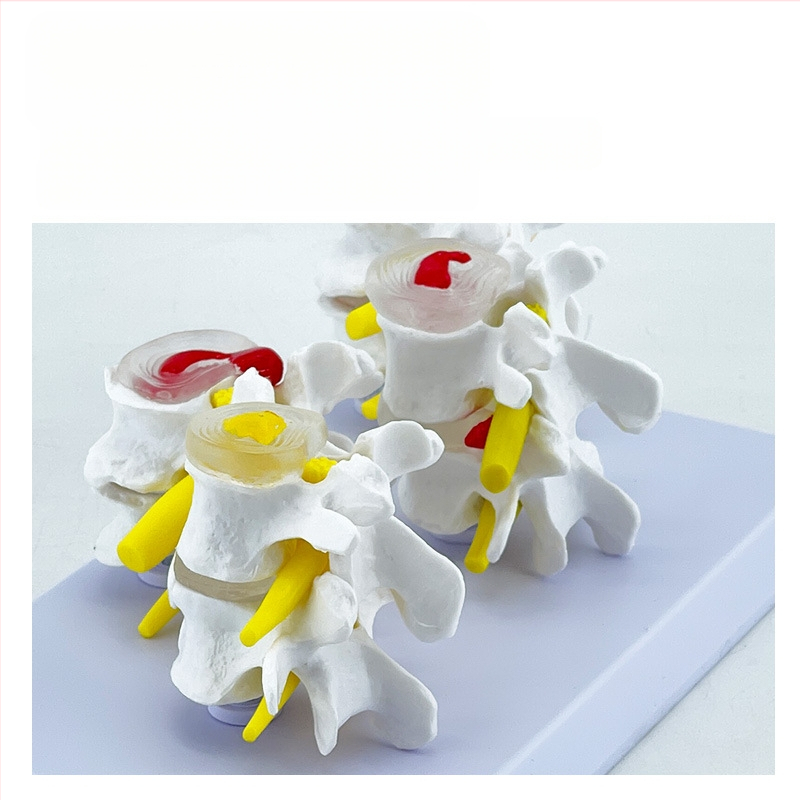 Blue Butterfly PVC четирисекционен модел на лумбалния гръбнак: нормални и патологични прешлени с дискова патология