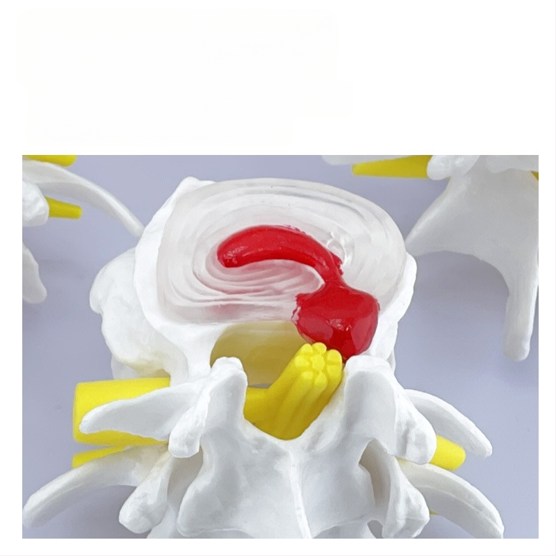 Blue Butterfly PVC четирисекционен модел на лумбалния гръбнак: нормални и патологични прешлени с дискова патология