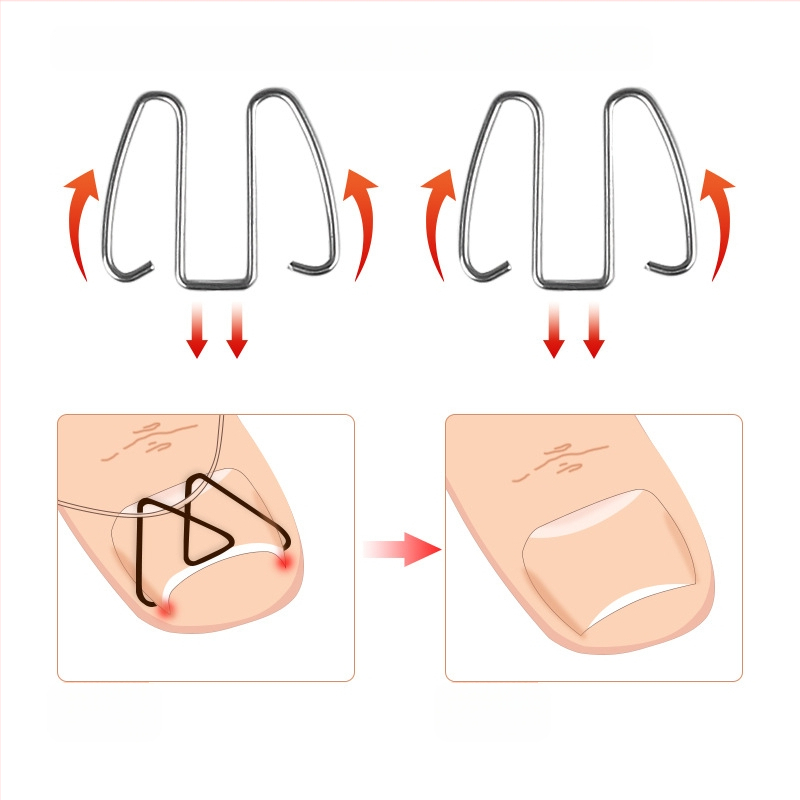 Ортеза за врастнал нокът на пръста; материал: пластмаса + неръждаема стомана; нето съдържание: 12.3; опаковка: 1000 бр; марка: Feet wake up