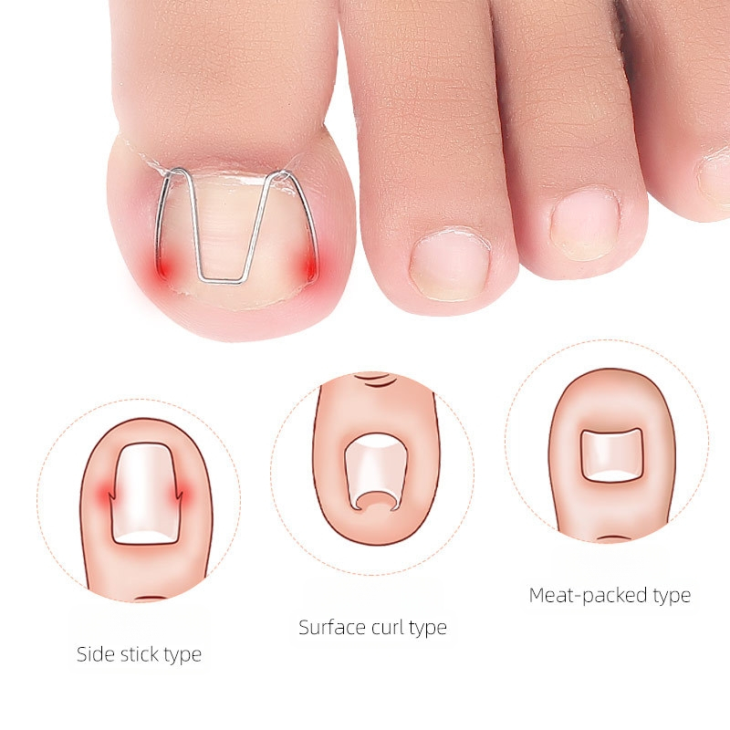 Ортеза за врастнал нокът на пръста; материал: пластмаса + неръждаема стомана; нето съдържание: 12.3; опаковка: 1000 бр; марка: Feet wake up