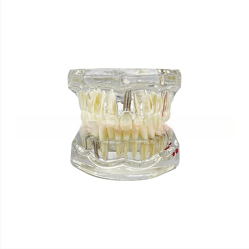 Οδοντιατρικό μοντέλο με παθολογικό στοιχείο, μοντέλο γέφυρας και εμφυτεύματος, αποσπώμενο, κατάλληλο για ενήλικες