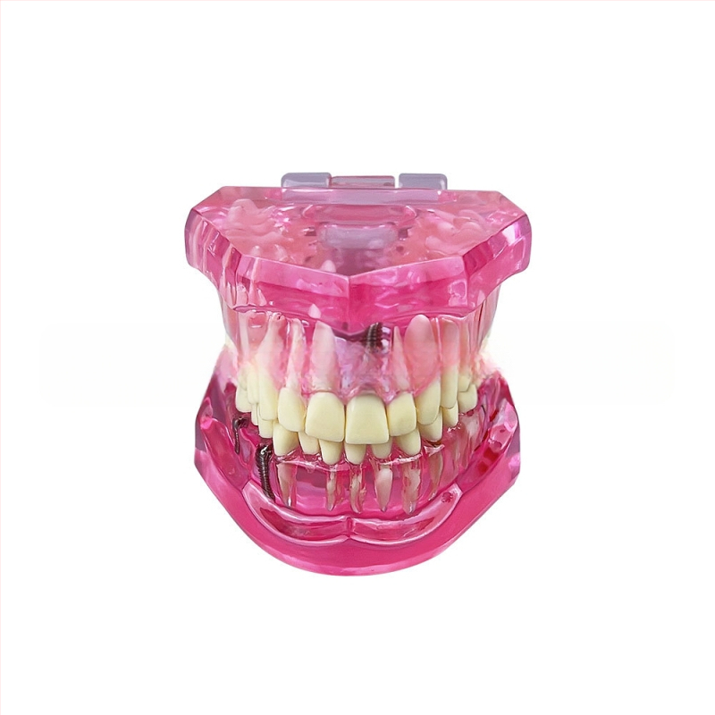 Οδοντιατρικό μοντέλο με παθολογικό στοιχείο, μοντέλο γέφυρας και εμφυτεύματος, αποσπώμενο, κατάλληλο για ενήλικες
