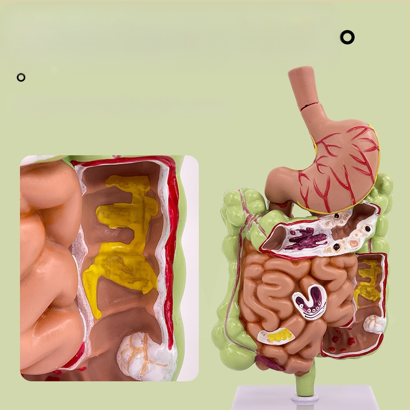 Модел на човешки стомах за анатомия — коронален разрез, патологичен модел със перфорация, обучение по гастроентерология