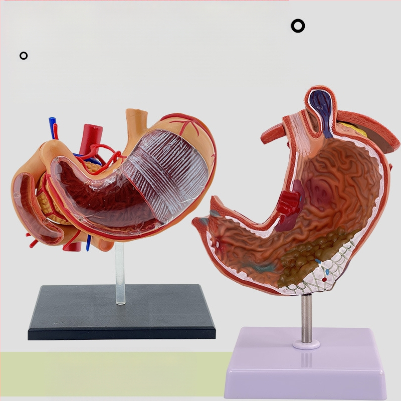 Модел на човешки стомах за анатомия — коронален разрез, патологичен модел със перфорация, обучение по гастроентерология