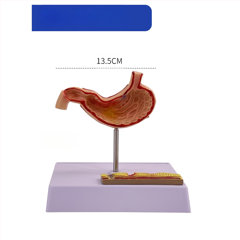 Модел на човешки стомах за анатомия — коронален разрез, патологичен модел със перфорация, обучение по гастроентерология