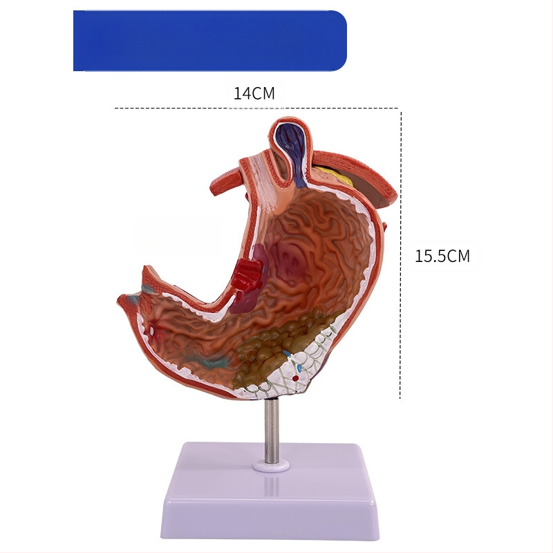 Модел на човешки стомах за анатомия — коронален разрез, патологичен модел със перфорация, обучение по гастроентерология