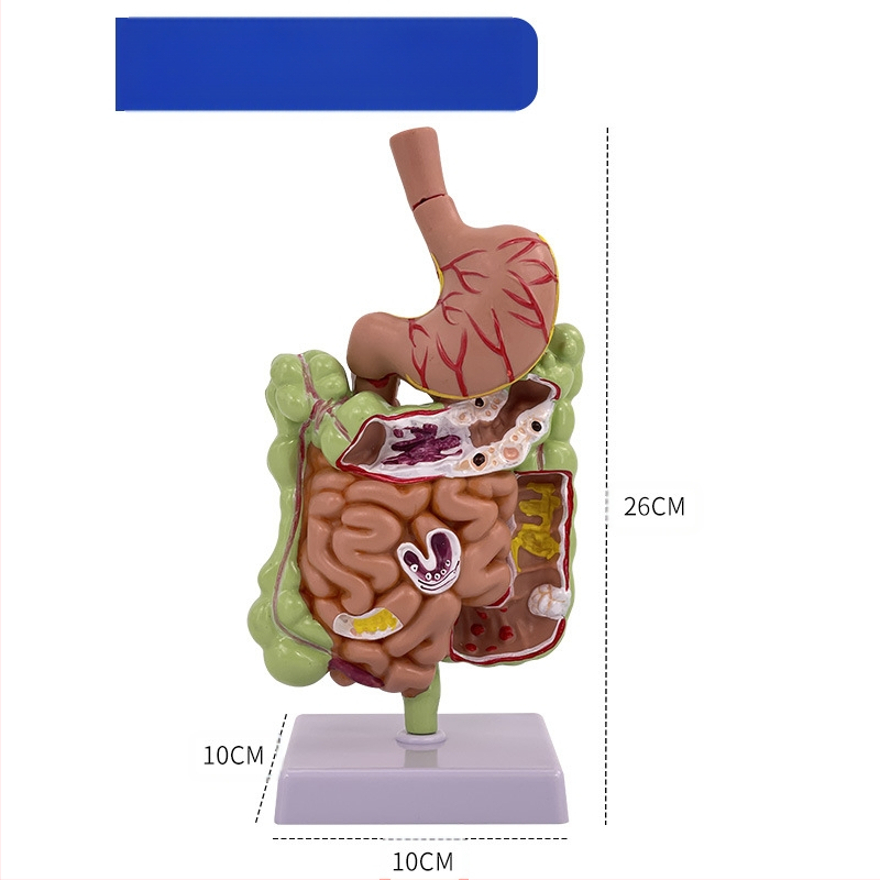 Модел на човешки стомах за анатомия — коронален разрез, патологичен модел със перфорация, обучение по гастроентерология