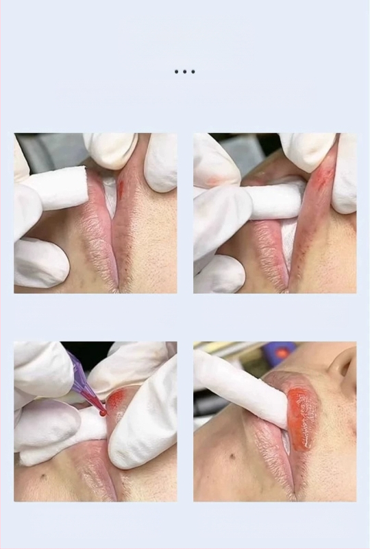 Antakių braižymo liniuotė – vienkartinė, pusiau nuolatinė, skaidri lipni skalė preciziniam išdėstymui, universalus naudojimas, be importo