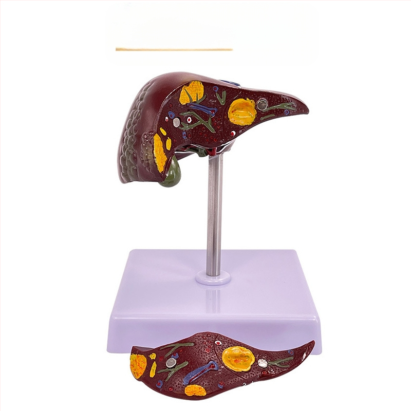 Ļoti reālistisks aknu anatomijas modelis ar hepatobiliāro–pankreato-splēnas-duodēnu sistēmu un reljefa bojājumiem