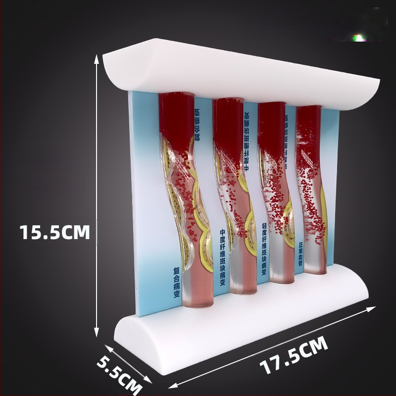 Dinaminis kraujagyslių modelis iš plastiko su didelio tankio užsikimšimu ir plokštelių trombu – mokymo modelis