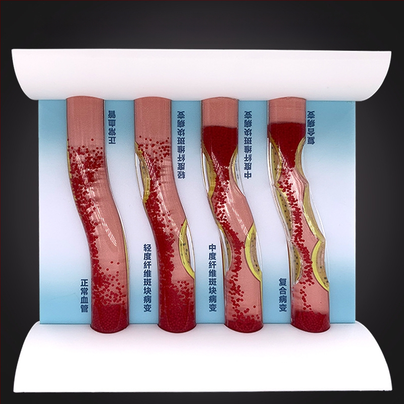 Dinaminis kraujagyslių modelis iš plastiko su didelio tankio užsikimšimu ir plokštelių trombu – mokymo modelis