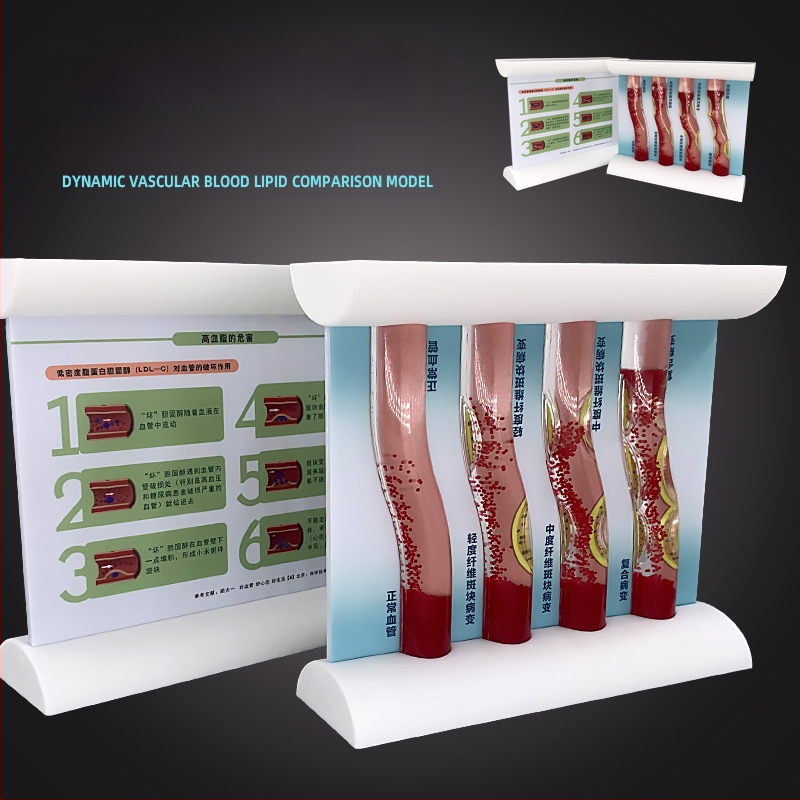 Dinaminis kraujagyslių modelis iš plastiko su didelio tankio užsikimšimu ir plokštelių trombu – mokymo modelis