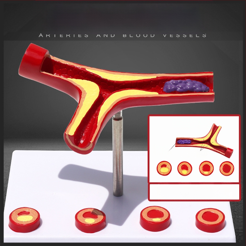Dinaminis kraujagyslių modelis iš plastiko su didelio tankio užsikimšimu ir plokštelių trombu – mokymo modelis