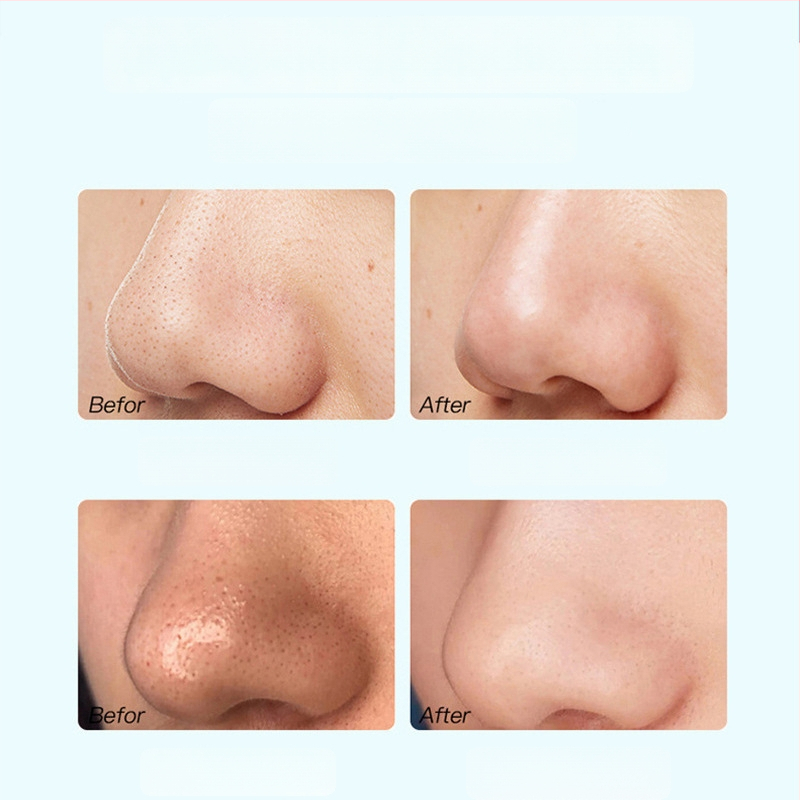 Teekstraktiga mustade laikude eemaldamise mask – kolmeosaleline komplekt, T-tsooni hooldus, pooride ahendamine, sebumi kontroll, niisutus