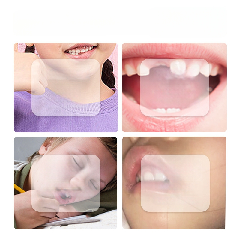 Huulelihaste treener suukaudse hingamise korrigeerimiseks – anti-snoring seade, täiskasvanutele, PP-materjal, kohandamiseta, adenoidses hüpertroofia kontekstis