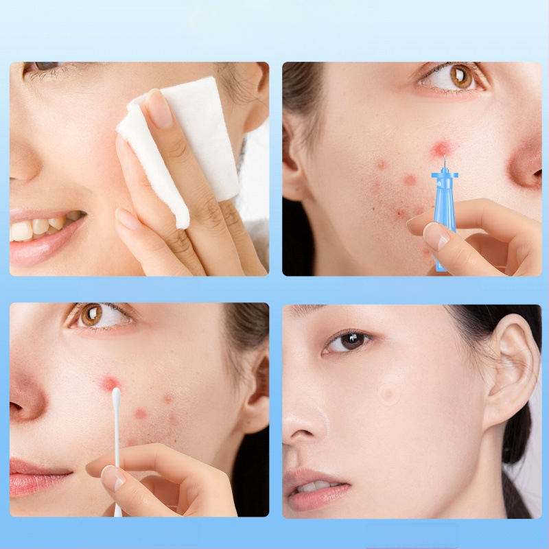 Vienkartinė nerūdijančio plieno spuogų išspaudimo adata, prekės kodas z7NAR7rA, prekė Kita