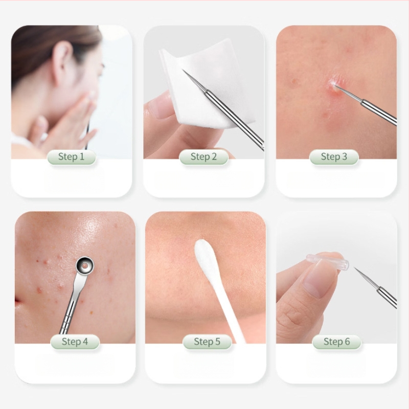 Nerūdijančio plieno aknės adatų rinkinys, 5 dalių, atnaujintas, tikslus juodųjų spuogų ir porų ekstraktorius