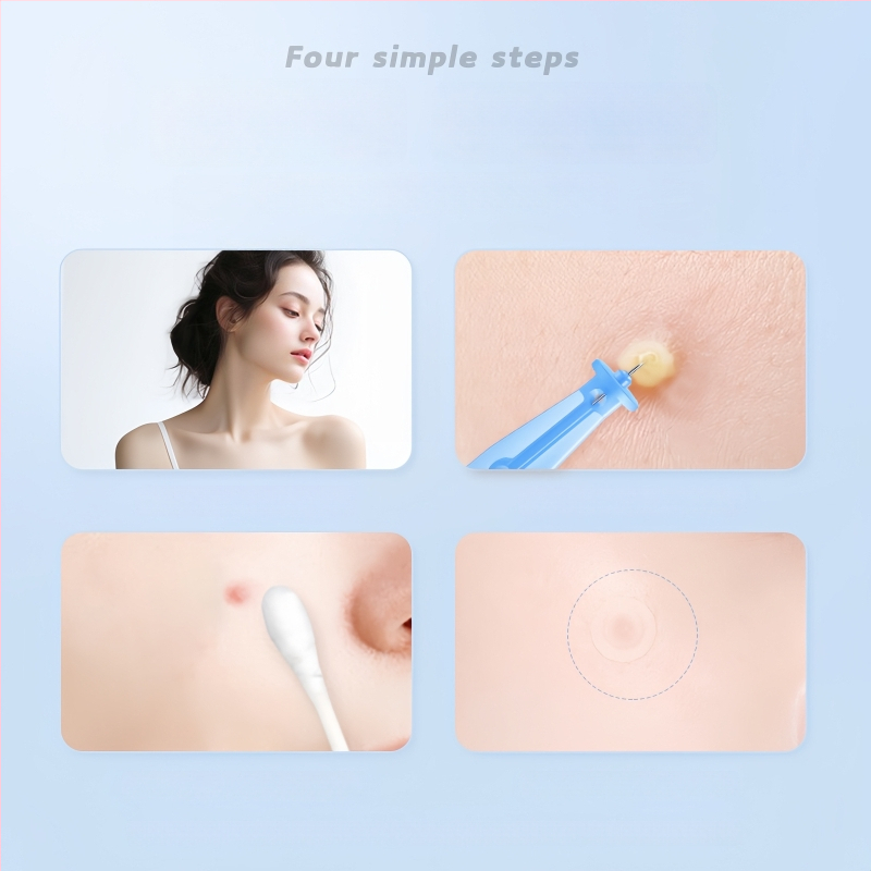 Vienkartinė nerūdijančio plieno aknės adata, skirta komedonams ir juodoms dėmėms (labai plona)